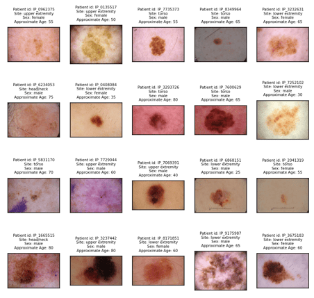 Multimodal ML for this melanoma detection model uses a patient’s structured data as well images of their lesions.